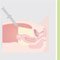 Hyst�rectomie par laparoscopie