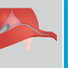Technique de ligature tubaire ESSURE