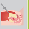 Hyst�rectomie par laparoscopie