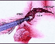 Hystérectomie (ablation de l'utérus) 