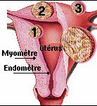 fibrome ut�rin