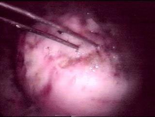 Fibrome transperc� par une �lectrode